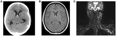 Horner's Syndrome as Initial Manifestation of Possible Brachial Plexopathy Neurolymphomatosis